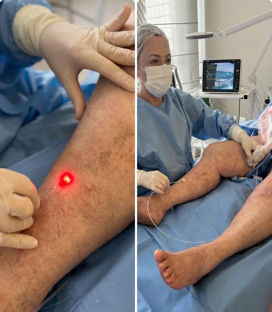 Procedimento de termoablação endovenosa com fibra de laser guiada por ultrassom